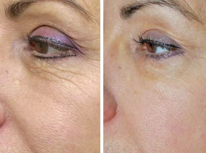 Mező lézer előtt és utána